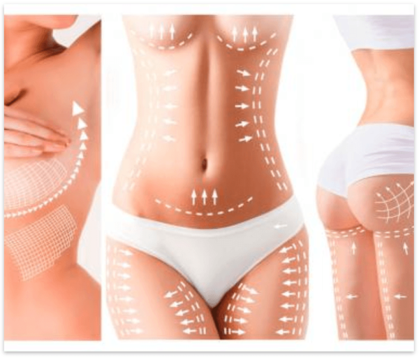 LIPOESCULTURA – LIPOASPIRACIÓN