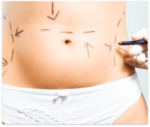 ABDOMINOPLASTÍA CIRCUNFERENCIAL
