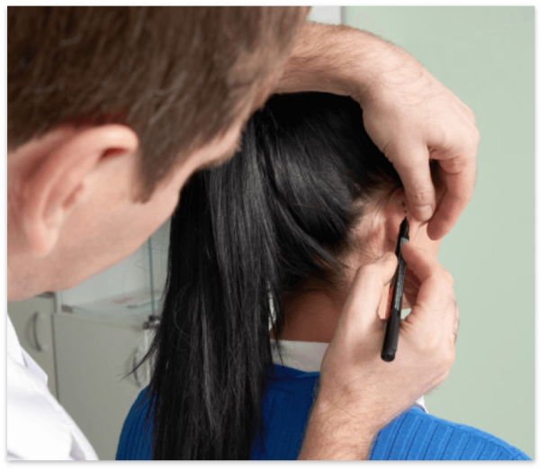 OTOPLASTÍA –  CIRUGIA DE LAS OREJAS