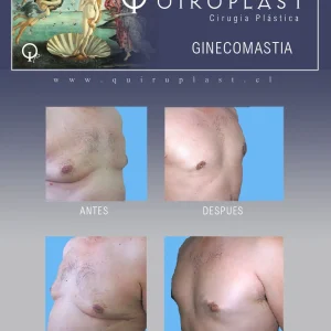 GINECOMASTIA