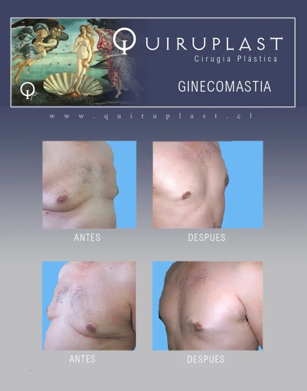 GINECOMASTIA
